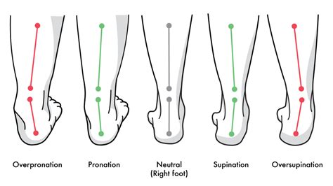 Overpronation Of Foot