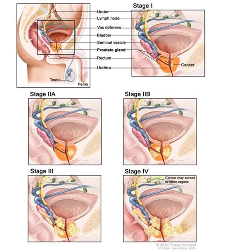 Prostate cancer: MedlinePlus Genetics