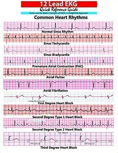 12 lead EKG Pocket Card - APRN world