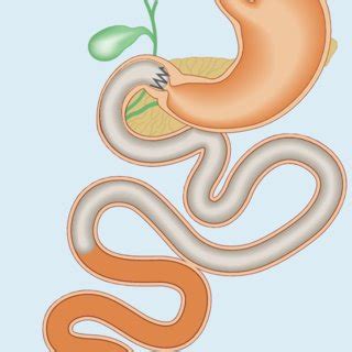 Diagram of fully deployed endoscopic duodenal-jejunal bypass sleeve... | Download Scientific Diagram