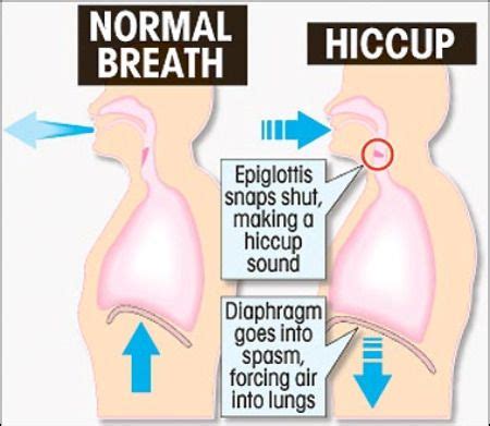 How To Get Rid of Hiccups