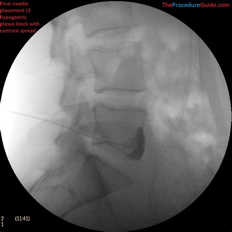 Hypogastric Plexus Block - Technique and Overview - The Procedure Guide