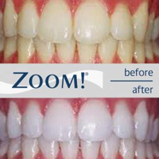 Zoom Whitening Midland Park, Wyckoff NJ | Midland Park Family Dentistry