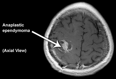 Ependymoma - Physiopedia