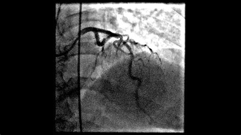 Heart catheterization stent - YouTube