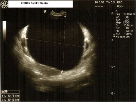 Ultrasound image of anechoic cyst. No septa were observed; thin walls... | Download Scientific ...