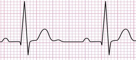 Electrocardiogram (ECG): working principle, normal ECG wave, application of ECG - Online Biology ...