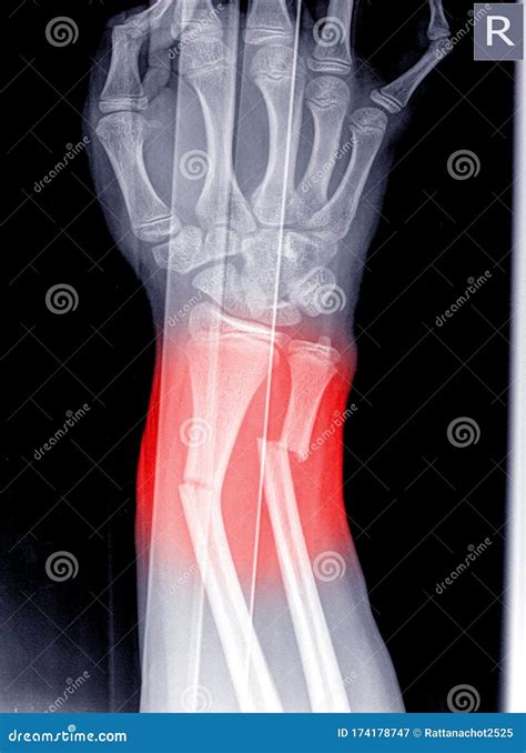 X Ray Of Human Hand With Broken Wrist Fracture Of Radius