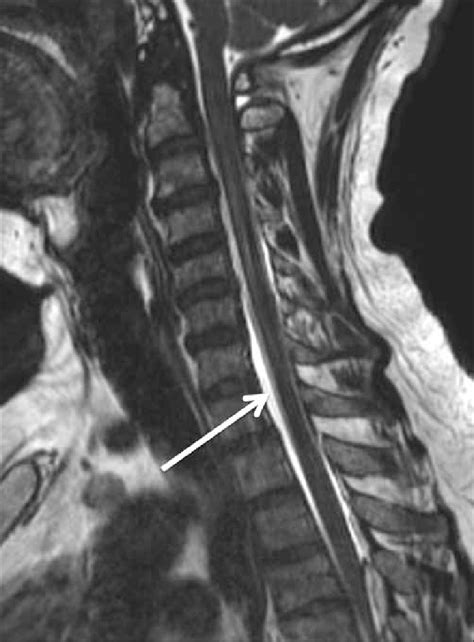 Sagittal MR myelography showing a thin layer of epidural CSF fluid ...