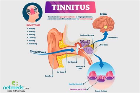 Selon une étude, ce traitement prometteur pourrait soigner les acouphènes | Hearing health ...