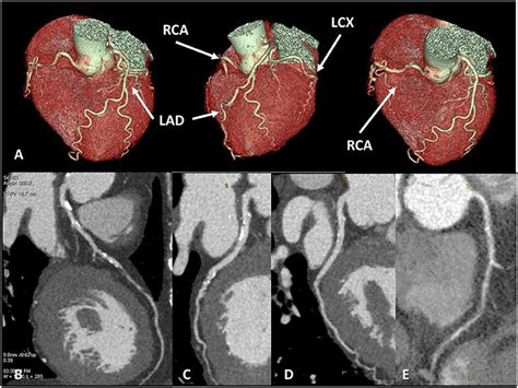 The Advantages Of A CT Coronary Angiogram