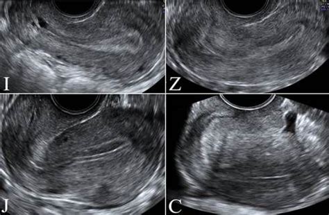 Prog Health Sci 2013, 3 (1), 78-82 Mrugacz | PROGRESS IN HEALTH SCIENCES | Ultrasound sonography ...