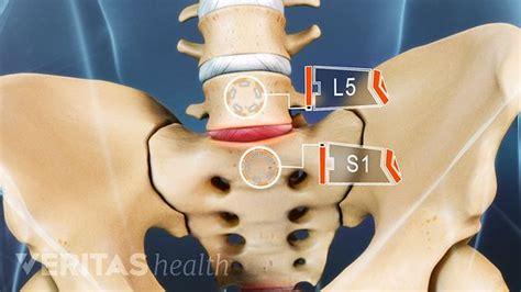 Understanding Isthmic Spondylolisthesis