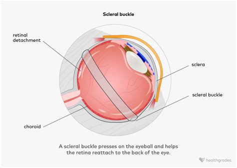 Scleral Buckle: Purpose, Procedure, and Recovery