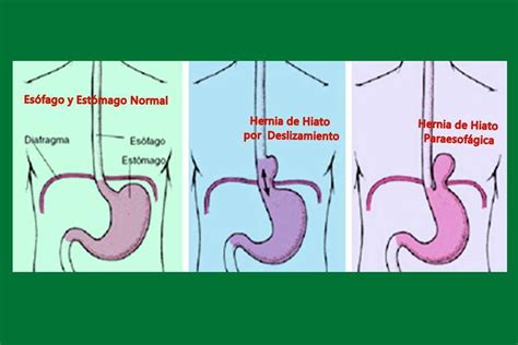 Síntomas de la Hernia de Hiato, Tipos |Dr. Francisco Belda Maruenda