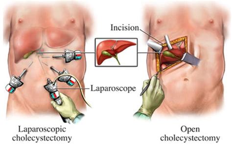 Problems after Gallbladder Removal (cholecystectomy)