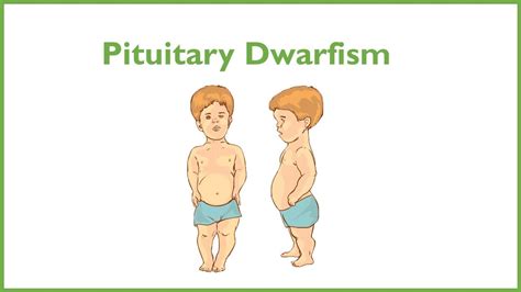 Pituitary Dwarfism Vs Achondroplasia Dwarfism