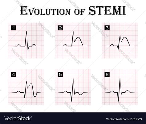 Ecg Changes With Stemi Images And Photos Finder | Images and Photos finder