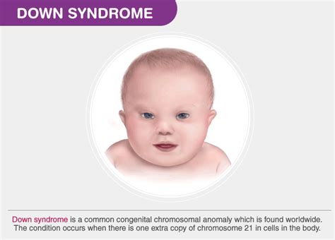 Down Syndrome | Symptoms and Diagnosis of Down Syndrome - Byju's