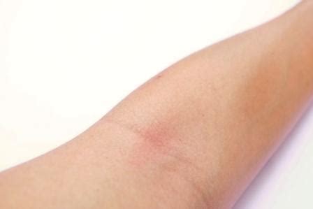 Intertrigo: Skin Fold Rashes: Causes, Ayurvedic Treatment, Remedies