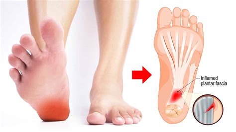 6 Plantar Fasciitis Stretches to Reduce Heel Pain | Power of Positivity