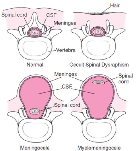 Figure: Forms of spina bifida - MSD Manual Professional Edition