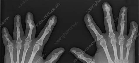 Psoriatic Arthritis, X-ray - Stock Image - C039/4334 - Science Photo Library