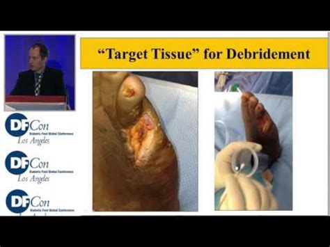 Wound Debridement - YouTube