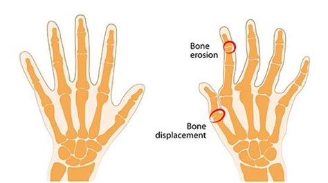 Ulnar Deviation Muscles