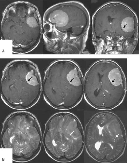 Sphenoid Wing Meningiomas | Clinical Gate