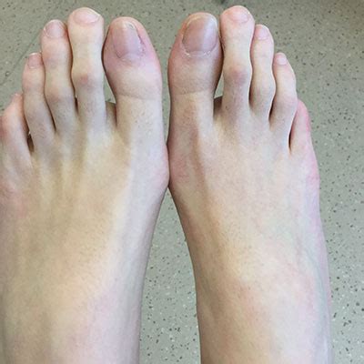 Toenail Fungus Archives - Ottawa Foot Clinic