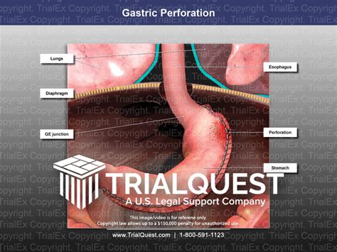 Gastric Perforation - TrialQuest Inc.