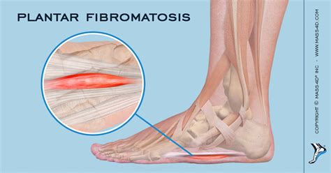 什么是足底纤维瘤病?- 爱游戏网址登录MASS4D®足部矫形器 - 爱游戏体育平台官网首页