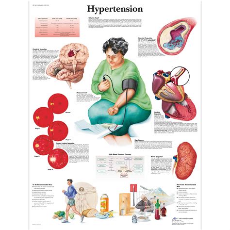 Hypertension Chart - SEM Trainers