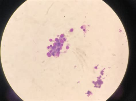 Urine cytology HPE image showed atypical urothelial cell | Download Scientific Diagram