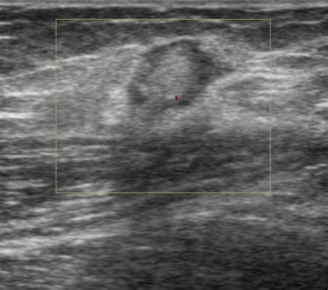 Medial epitrochlear lymphadenopathy | Image | Radiopaedia.org