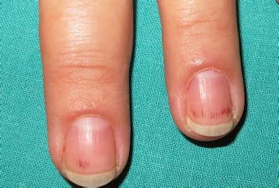 Hemorragia en astilla Vía dermapixel | Nails, Beauty hacks, Beauty