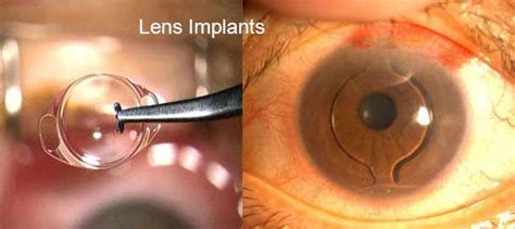 A Tale of IOL (Intraocular Lens) Surgery Procedures - endmyopia.org