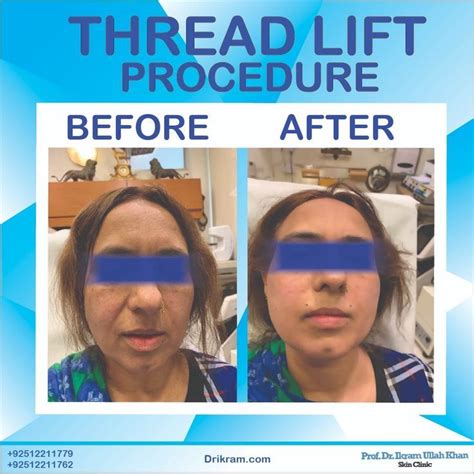 Thread lift procedure – Artofit