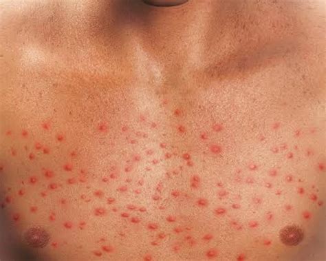 Cirrhosis Rash: Is Your Rash Caused By Hepatitis? - Fatty Liver Disease