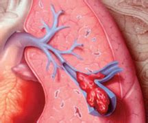 Pulmonary Embolism Symptoms, Causes and Treatment | Health And Beauty