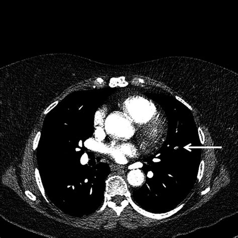 Lower prevalence of subsegmental pulmonary embolism after application of the YEARS diagnostic ...