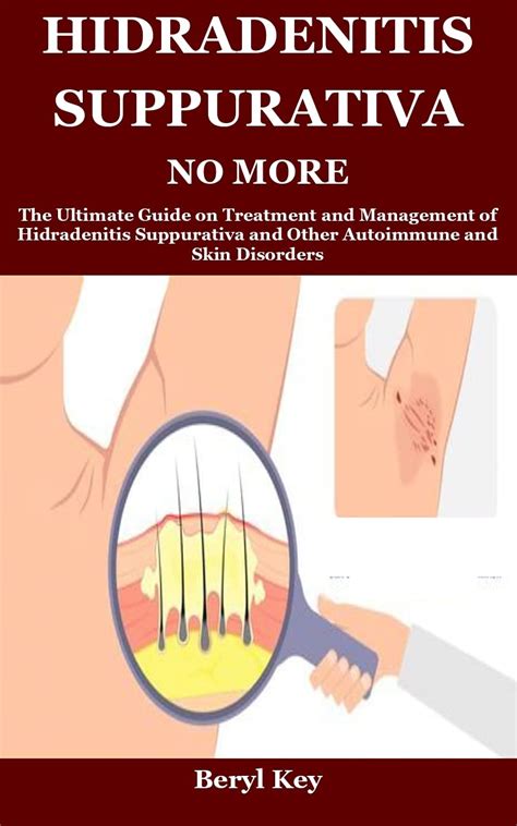 Buy HIDRADENITIS SUPPURATIVA NO MORE: The Ultimate Guide on and Management of Hidradenitis ...