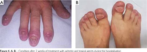 Figure 4 from Acrodermatitis continua Hallopeau | Semantic Scholar