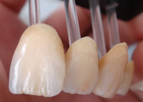 Emax Crowns- Durable and Affordable Barth IPS Emax Crowns