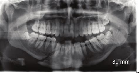 Mandibular Fracture X Ray