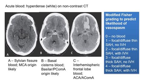 Subarachnoid Haemorrhage - YouTube