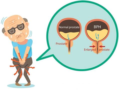 Benign Prostatic Hyperplasia Enlarged Prostate