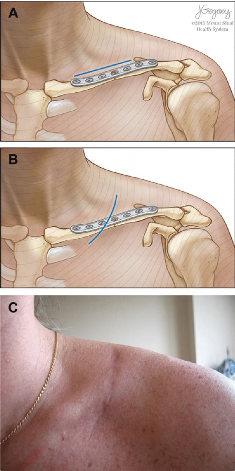 (A) The longitudinal incision for open reduction and internal fixation ...