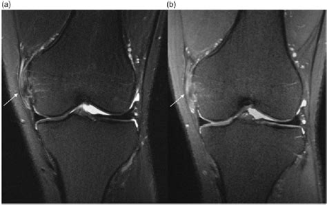 Images of a 21-year-old male patient with MCL tear detected at coronal... | Download Scientific ...